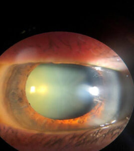 Close-up of an eye displaying a cataract, characterized by a cloudy yellow haze within the pupil, illustrating the condition discussed in relation to cataract surgery options at Henry Eye Clinic.